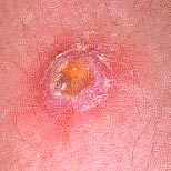 Mrsa On Skin