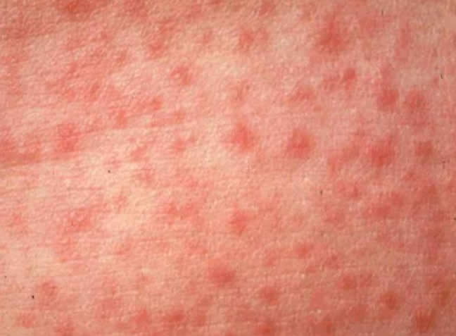 BioSpray Measles Outbreak Control